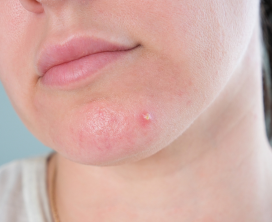 Cheek & Chin Contouring