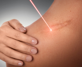 Scar Revision & Correction