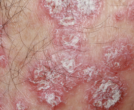 Psoriasis Maintenance Therapy