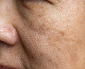 Pigmentation & Dark Spot Removal