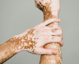 Melanocyte Transplantation Therapy