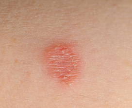 Ringworm (Tinea) Treatment