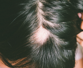 Hair Fall Control & Regrowth