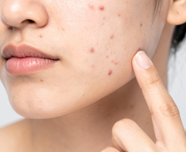 Acne & Pimple Treatment