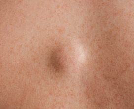 Back & Arm Lipoma Removal