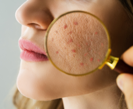 Targeted Acne Scar Repair