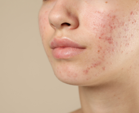 Acne Scar Reduction