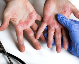 Contact Dermatitis Treatment