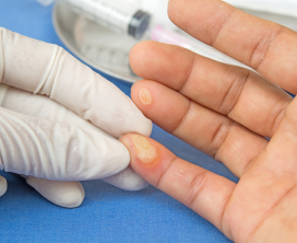 Hand & Finger Warts Treatment