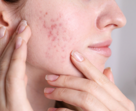 Comprehensive Acne & Scar Care