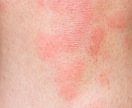 Hives (Urticaria) Treatment