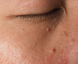 Facial Warts Removal