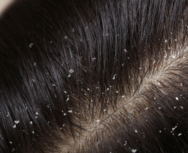 Scalp & Dandruff Treatments