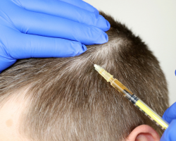 Mesotherapy for Hair Regrowth