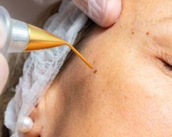 Scar-Free Cosmetic Wart Correction