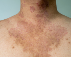 Allergic Skin Reaction Therapy