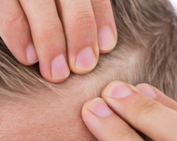 Hairline Reconstruction & Redefinition