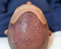 Scalp Micropigmentation (SMP) for Hair Thinning