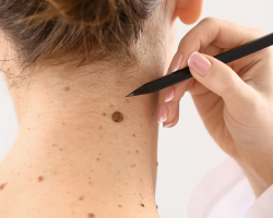 Skin Tag Removal