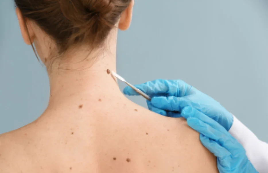 Skin Tag Removal